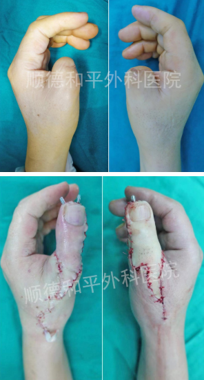 3d全型手指再造,佛山骨科医院断指再造方法 – 连线家