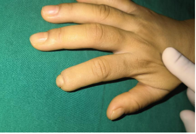 佛山3d全型手指再造是真手指吗哪家医院可以做3d再造