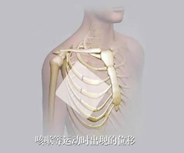 杭州博颂科技医用肋骨固定板 杭州博颂科技医用肋骨固定板