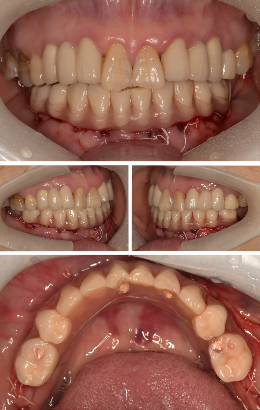 下颌6雕牙步骤图片