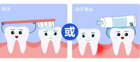 牙本质,牙科脱敏剂,济宁口腔护理