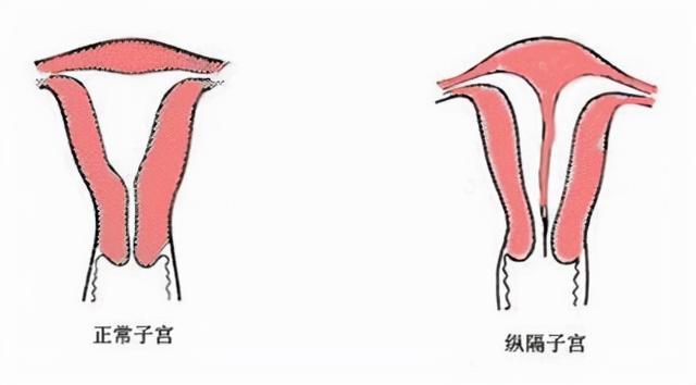 而纵隔子宫按照严重程度可分为完全纵隔子宫和不全纵隔子宫.