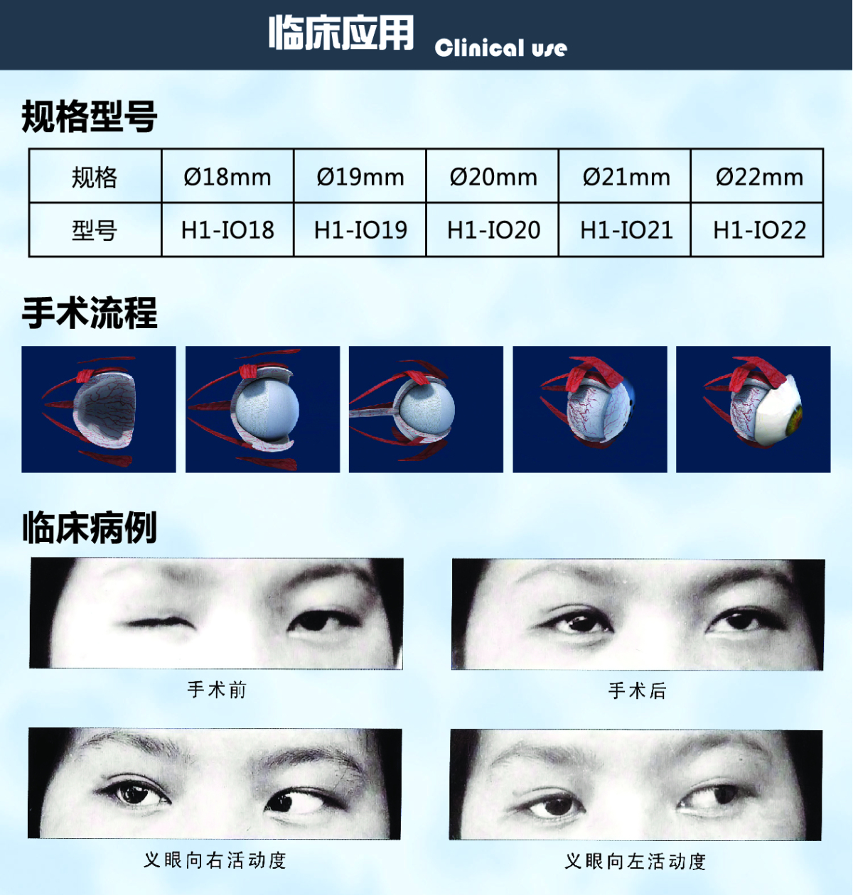 贝奥路羟基磷灰石义眼台使用说明