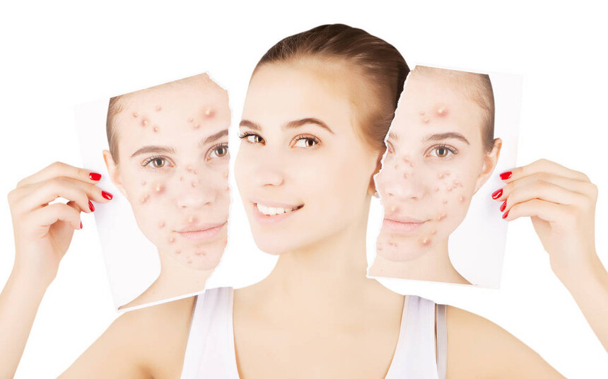 acne skin wholelinebeauty.jpeg