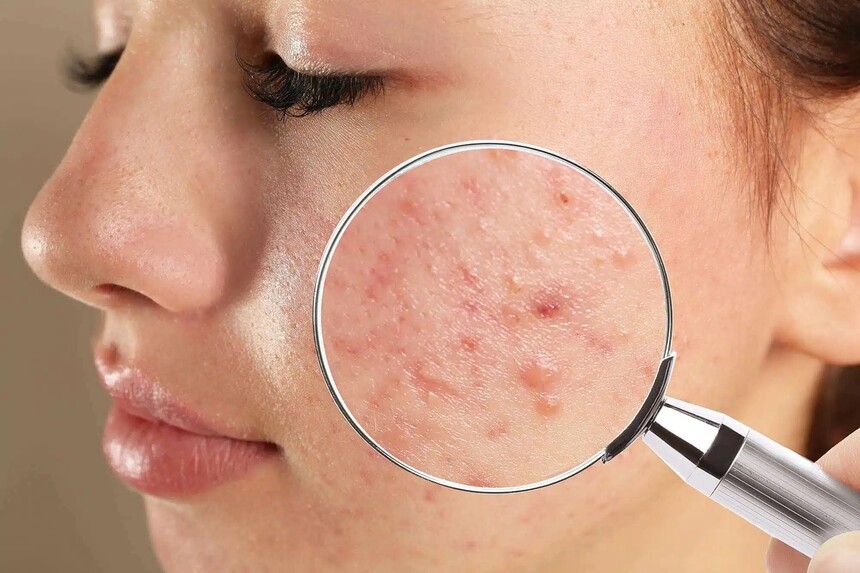skincare ingredients for acne skin.jpg