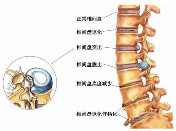 你必須知道的腰椎小知識