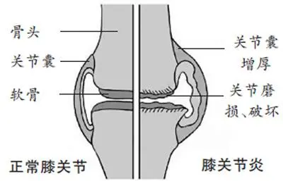 認識骨關(guan) 節病