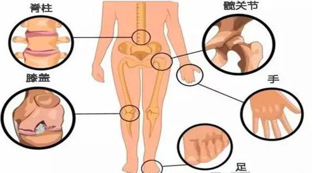 認識骨關(guan) 節病