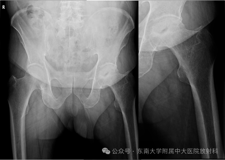 股骨頭缺血壞死影像診斷