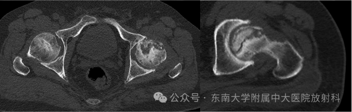 股骨頭缺血壞死影像診斷