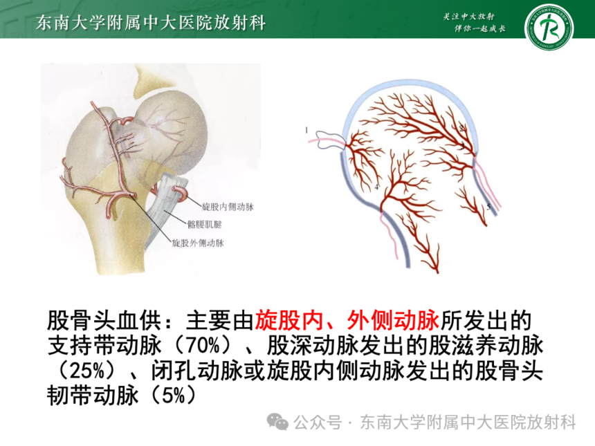股骨頭缺血壞死影像診斷