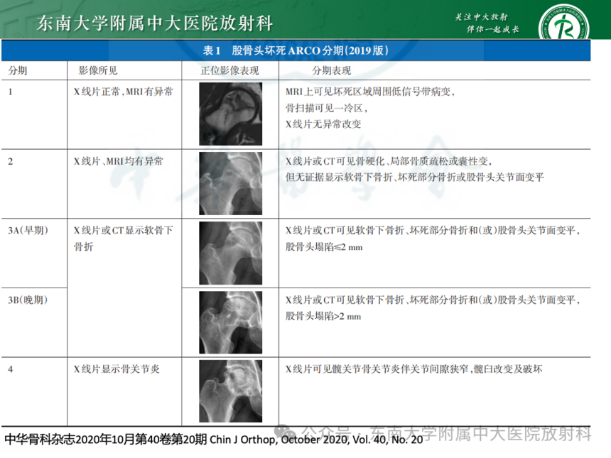 股骨頭缺血壞死影像診斷