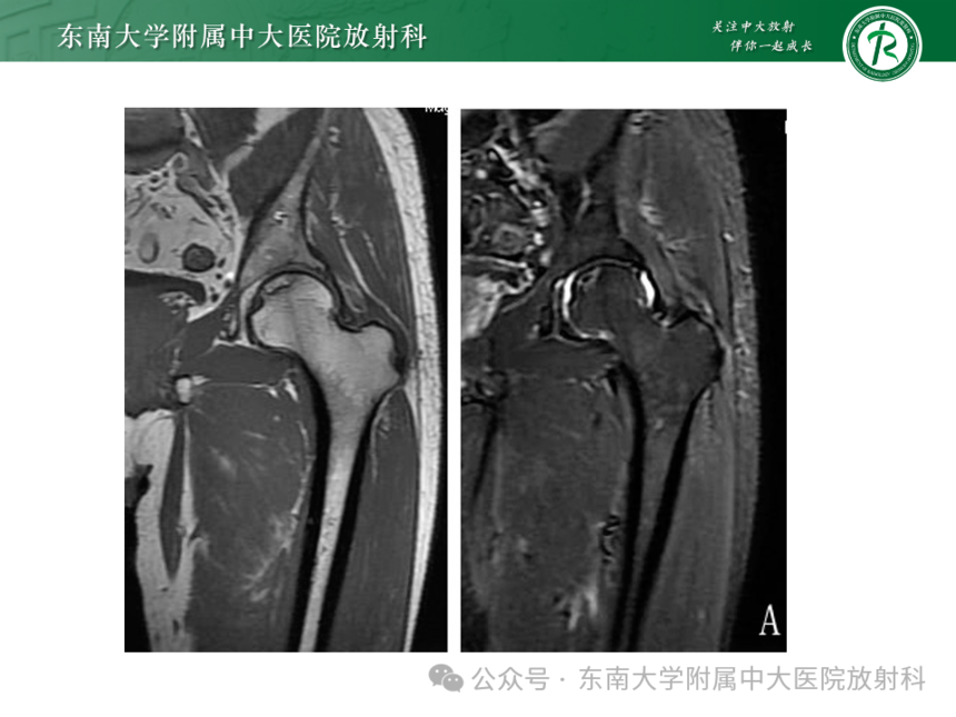 股骨頭缺血壞死影像診斷