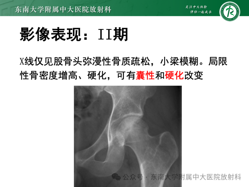 股骨頭缺血壞死影像診斷
