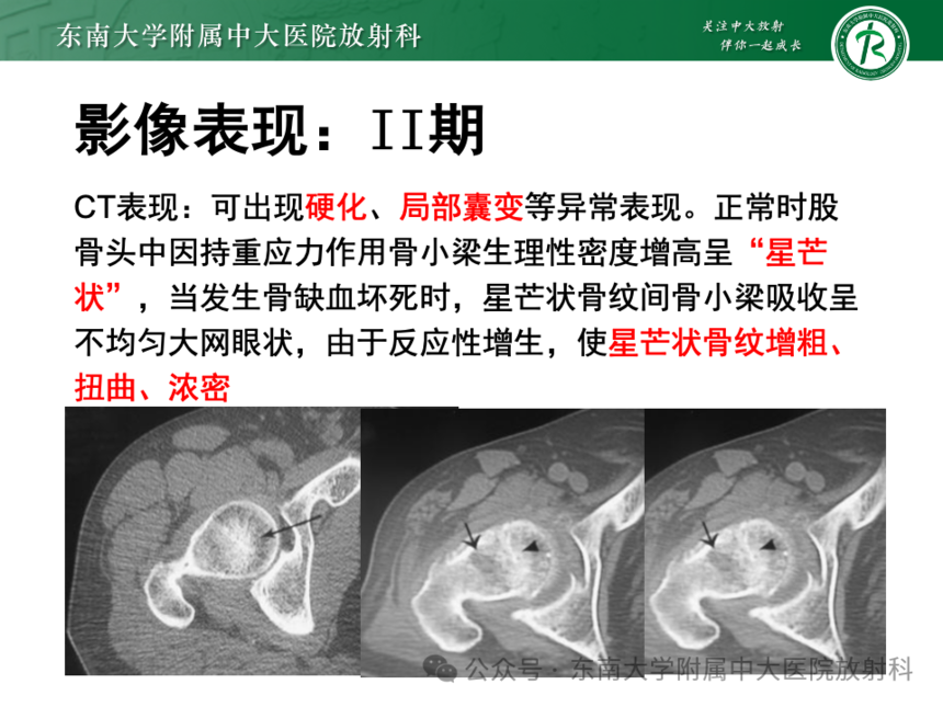 股骨頭缺血壞死影像診斷