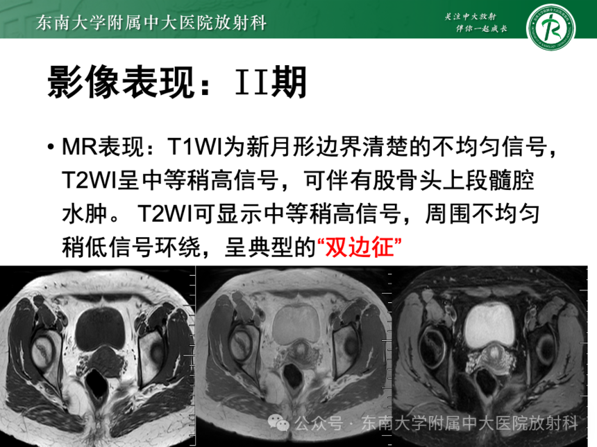 股骨頭缺血壞死影像診斷