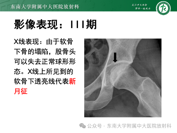 股骨頭缺血壞死影像診斷