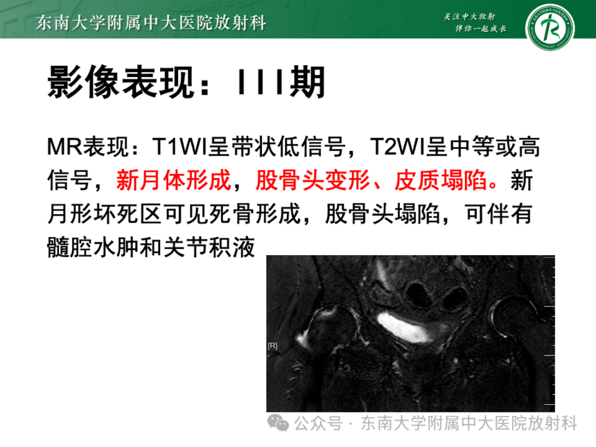 股骨頭缺血壞死影像診斷