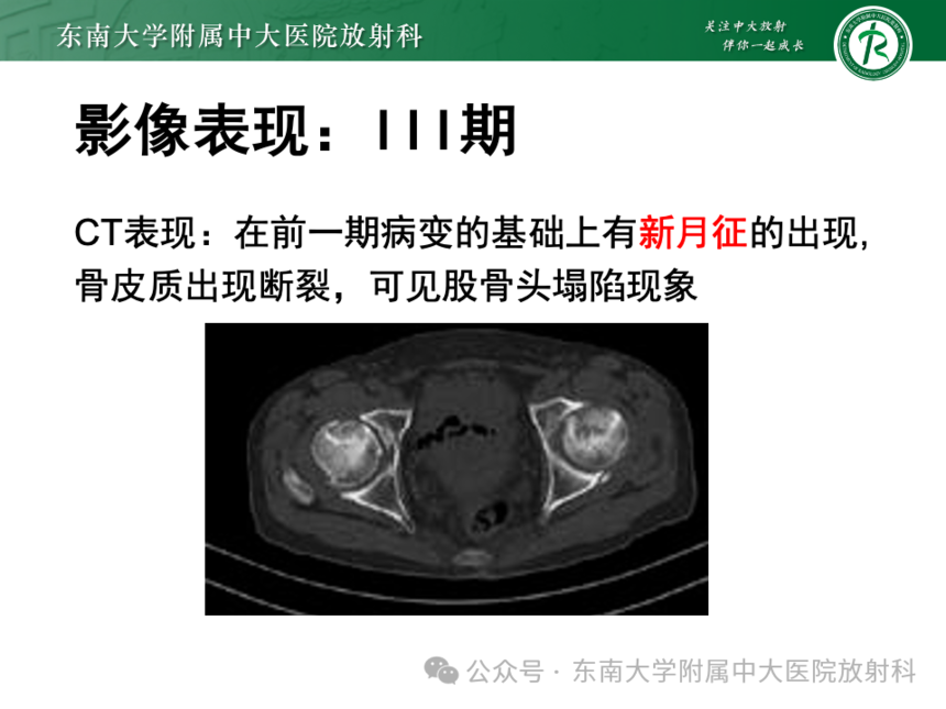 股骨頭缺血壞死影像診斷