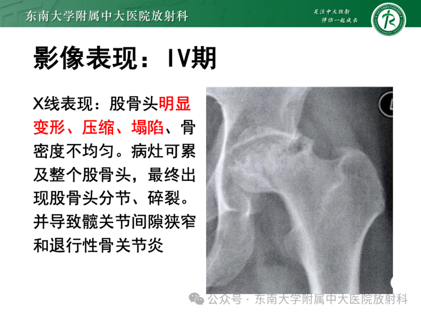 股骨頭缺血壞死影像診斷