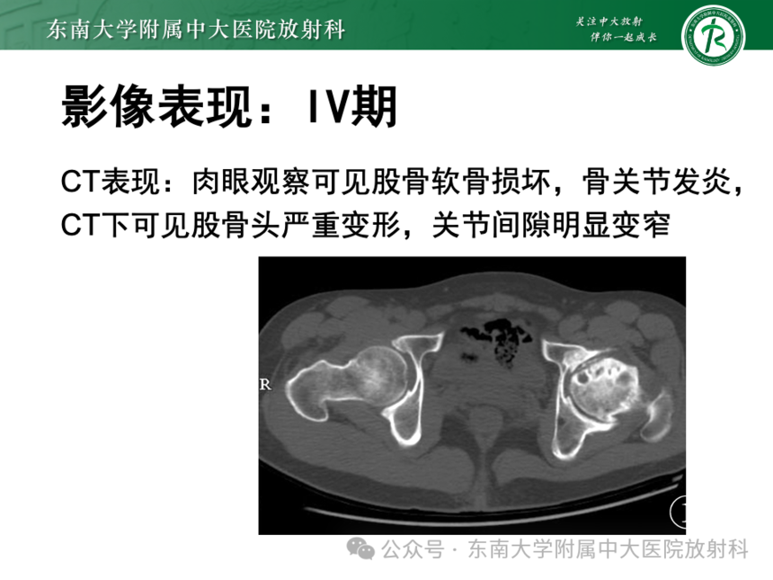 股骨頭缺血壞死影像診斷