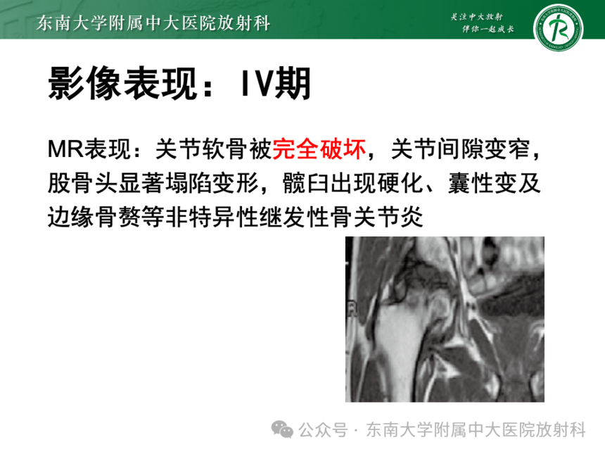 股骨頭缺血壞死影像診斷