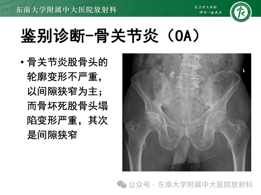股骨頭缺血壞死影像診斷