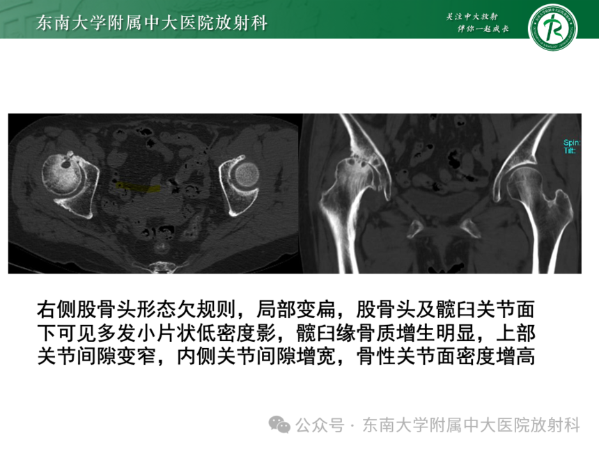 股骨頭缺血壞死影像診斷
