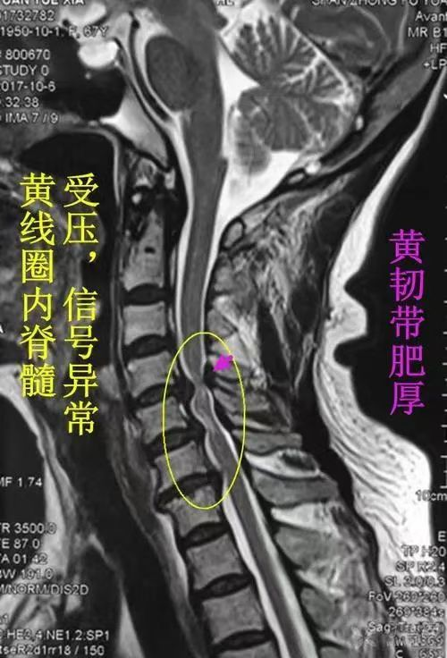 什麽(me) 是脊髓型頸椎病