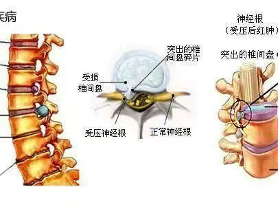 腰椎間盤突出的危害有哪些？
