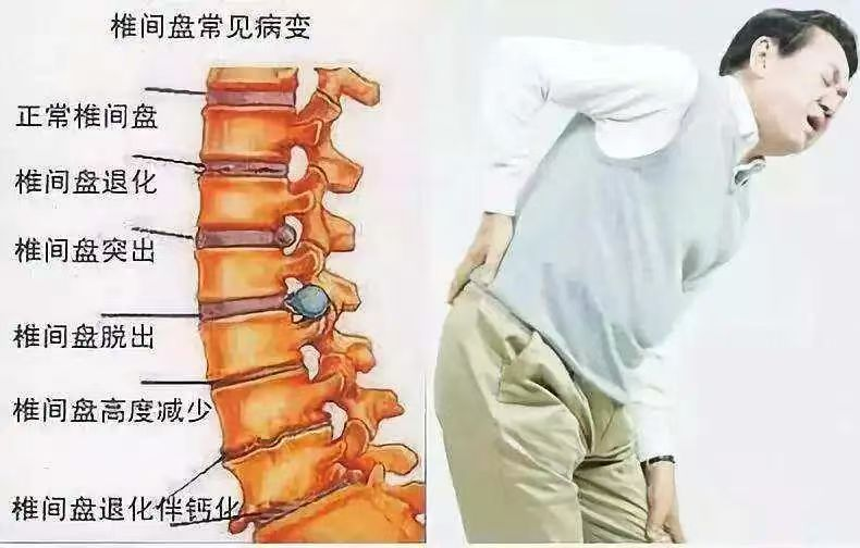 腰椎間盤患者如何緩解疼痛
