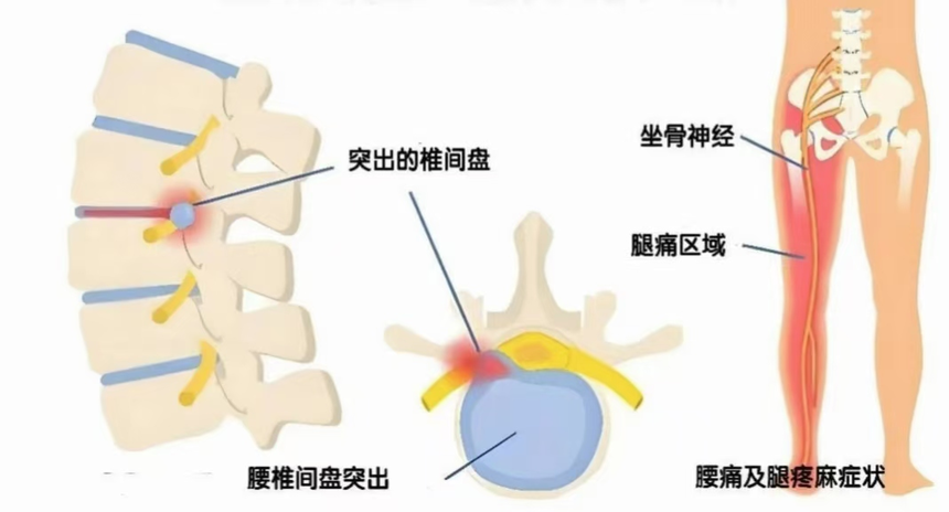 腰椎間盤突出是怎麽(me) 產(chan) 生的？