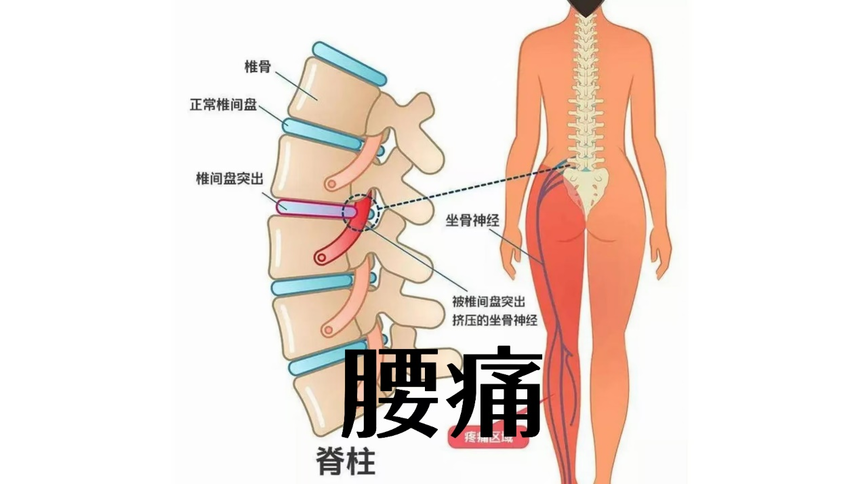 中醫在治療腰痛時，如何根據病情和體(ti) 質選擇合適的治療方法