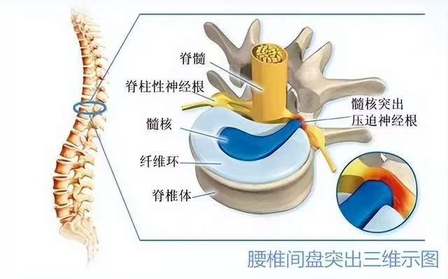 腰椎間盤突出的中醫保守治療