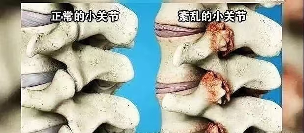 腰椎小關(guan) 節紊亂(luan) 科普