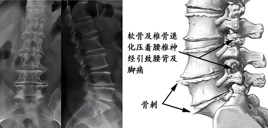 中醫說—腰痛的中醫辨證施治
