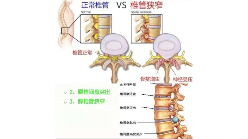 腰椎間盤突出和腰椎管狹窄的區別