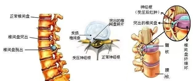 腰椎間盤疼痛的特點有哪些？