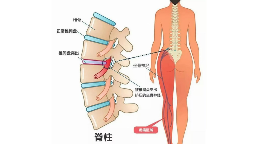 腰椎間盤疼痛的特點有哪些？