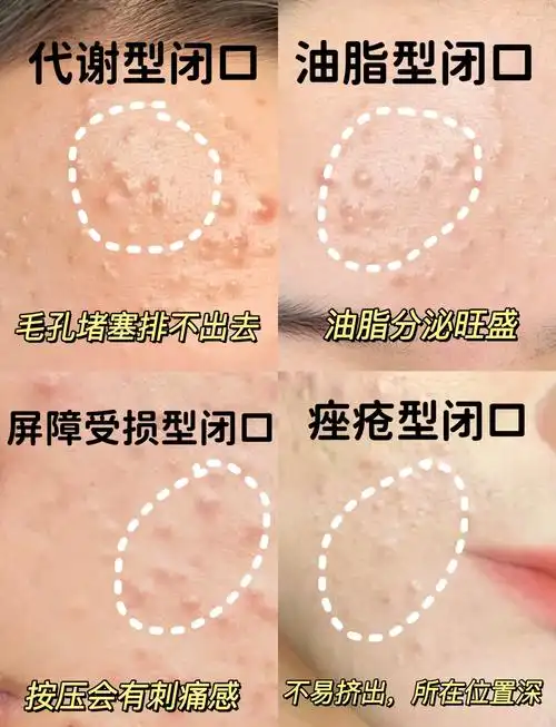 1742011774980538.png 闭口.png