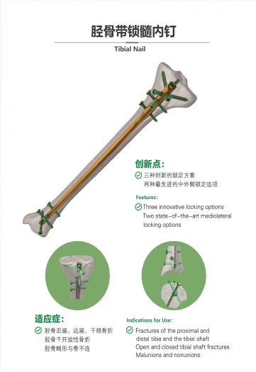 脛骨帶鎖髓內(nèi)釘