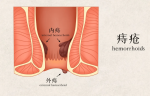 haemorrhoids