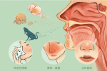 allergic rhinitis