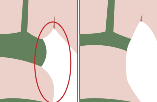 ��֬����Ƥ���᲻���ɳڣ�