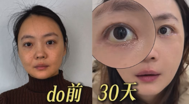 苹果肌提升切口 苹果肌提升切口
