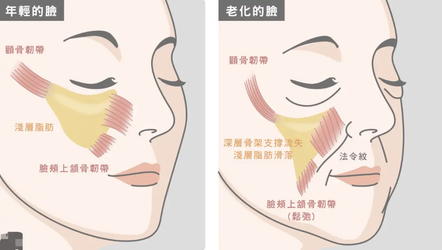 苹果肌下垂 苹果肌下垂
