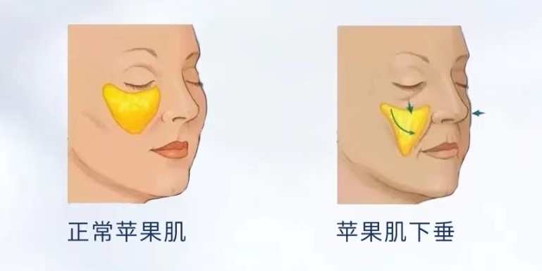 苹果肌复位医生十大排行榜 苹果肌复位医生十大排行榜