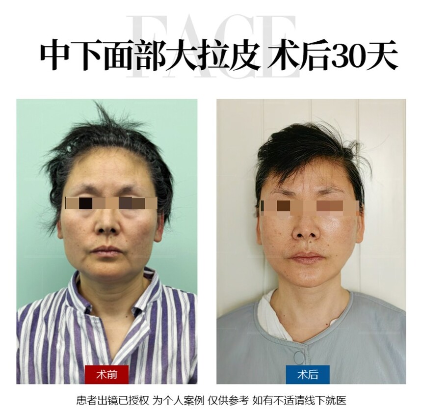 魏广运大拉皮案例.jpg 魏广运大拉皮案例.jpg
