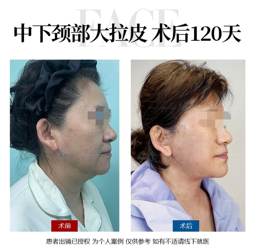 面部拉皮.jpg 面部拉皮.jpg
