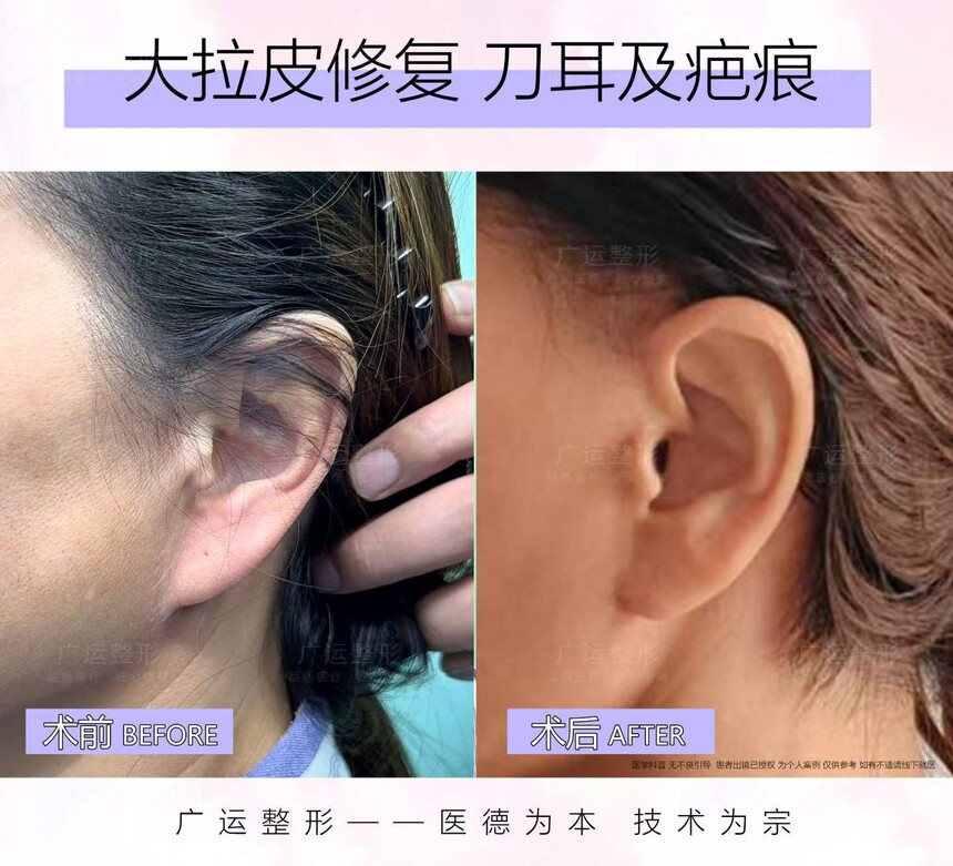 魏广运拉皮修复案例.jpg 魏广运拉皮修复案例.jpg